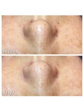 フィエルテ(Fielte)/毛穴/くすみ/艶肌