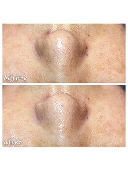 フィエルテ(Fielte)/毛穴/くすみ/艶肌