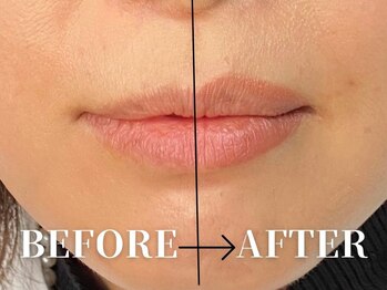 ビューティーマップ 銀座(BEAUTY MAP)/人中短縮メイクBEFORE・AFTER