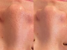 リラ(Lilas)/毛穴洗浄×韓国ハーブ1回の変化