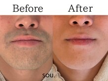 【結果重視】びっくりするほど早くツルツルなお肌に劇的変身！