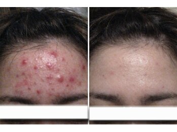 マロン(MARON)/おでこニキビ改善例