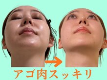 ナチュラルパーフェクトフェイス 新宿/二重顎、顎肉スッキリ/新宿小顔