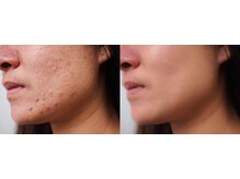 パーフェクトフェイスビューティー 梅田店(PERFECT FACE BEAUTY)/ニキビケア