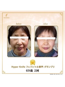 リンカ(Rinka.)/☆帯広初!!ハイパーナイフ導入☆