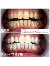 ホワイトニングサロン 京都烏丸店/ホワイトニング施術例
