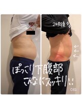 OBS新潟整骨院/脂肪冷却の効果