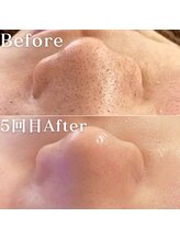 ミニョスキンラボ/韓国式ハーブピーリング5回