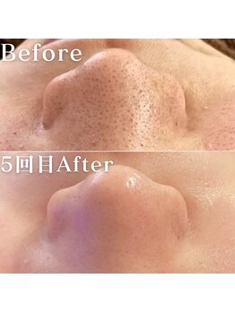 ミニョスキンラボ/韓国式ハーブピーリング5回