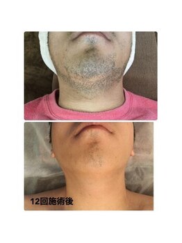 ルアナ(Luana)/メンズ脱毛　ヒゲ脱毛