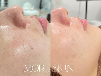 モアスキン 南青山店(MORE SKIN)/頑固に見える毛穴のカスタムケア