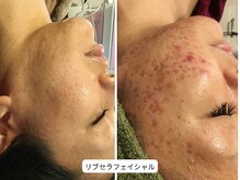 サロン アンネ(Anne)/リブセラフェイシャル