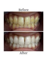 エクシアホワイトニング 相模大野店/ビフォーアフター