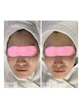 エクスクラメーションマーク(!!!)/超音波リフトアップ