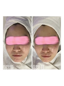 エクスクラメーションマーク(!!!)/超音波リフトアップ