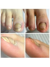 ドクターネイル爪革命 十条店/肥厚爪ケア