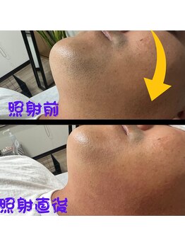 フェリッセ(FELISSE)/ヒゲ 照射前と照射直後の違い