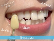 ホワイトニングカフェ 岸和田店(WhiteningCafe)の雰囲気（1度で効果実感♪差し歯や詰め物があってもホワイトニング可能！）