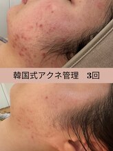 ビューティーセイバー 馬車道(BEAUTY SAVIOR) ニキビ管理 が得意