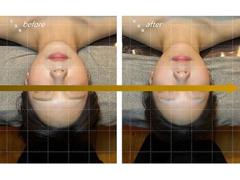 エムズプレミアム(M’s Premium)/4回目の施術