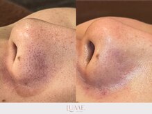 ルーミー 南青山(LUME)/毛穴の黒ずみ／産毛／ワックス