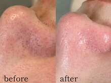 ウィズルーチェ 神栖店(with luce)/毛穴洗浄１回効果★鼻黒ずみ毛穴