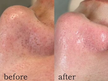 ウィズルーチェ 神栖店(with luce)/毛穴洗浄１回効果★鼻黒ずみ毛穴