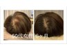 美髪再生育毛促進鍼体験＋カウンセリング　毎月５名限定　新規限定4,980円