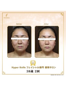 リンカ(Rinka.)/☆帯広初!!ハイパーナイフ導入☆