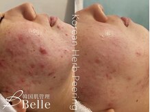 ベル 桜木町(Belle)/ハーブピーリング｜フェイシャル