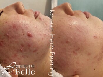 ベル 桜木町(Belle)/ハーブピーリング｜フェイシャル