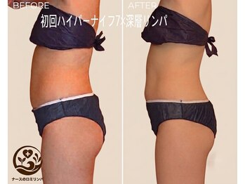 ナースのロミリンパの写真/ハイパーナイフ7×深層リンパで理想のくびれ作り！お腹・ウエストラインへ徹底集中アプローチ
