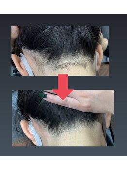 しん整骨院/うなじ脱毛