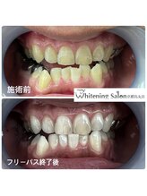 ホワイトニングサロン 京都烏丸店/ホワイトニング施術例