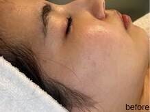 サロン ド エメ(salon de aimer)/【Before】赤み、くすみに