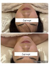 ルピナージュ(Lupinage)/【肌質改善】‐小顔ヘッドスパ‐