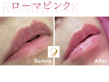 ツキ(TUKI+)/ローマピンク★全身の黒ずみ除去