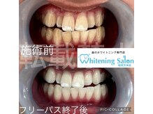 ホワイトニングサロン 福岡天神店/ホワイトニング