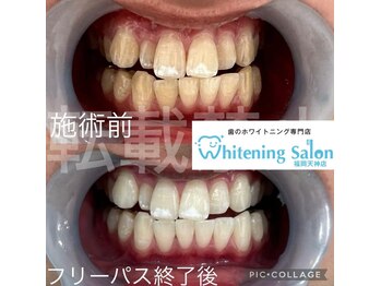 ホワイトニングサロン 福岡天神店/ホワイトニング