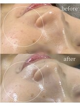 サロンナナジュウニ(Salon72)/ニキビ/肌荒れ