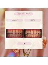 プラスビー 3号店(+b)/ホワイトニングビフォーアフター
