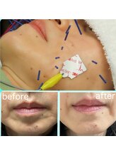 あおば接骨院/ほうれい線・たるみ改善／美容鍼