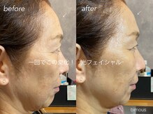 ビモアス(bimous)