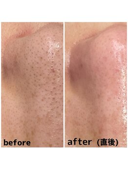 ティーティービューティー(TT Beauty)/毛穴エクストラクション