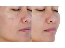 パーフェクトフェイスビューティー 梅田店(PERFECT FACE BEAUTY)/シミ改善