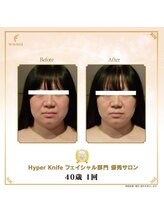 リンカ(Rinka.)/☆帯広初!!ハイパーナイフ導入☆