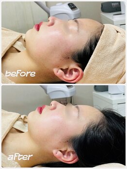 KMB 恵比寿店/毛穴洗浄&光&炭酸ガスパック