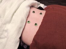 鍼灸マッサージ治療室にしざわ/灸施術