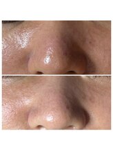 ベル(Bell)/毛穴ケア