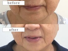 ビューティズムラウンジ(Beautism Lounge)/たるみ改善エステ